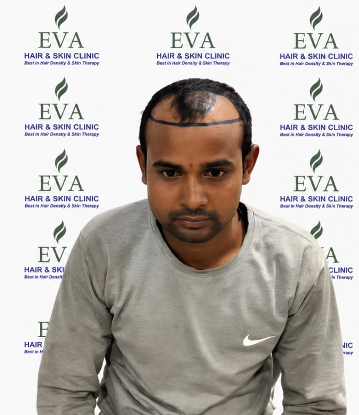 Before hair transplant result 7